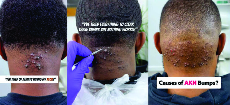 razor treatment royalluxury 1