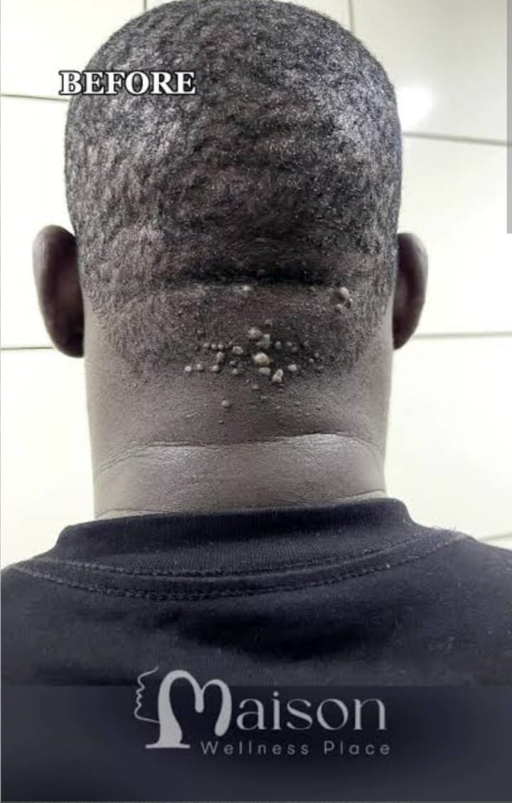razor treatment royalluxury 4