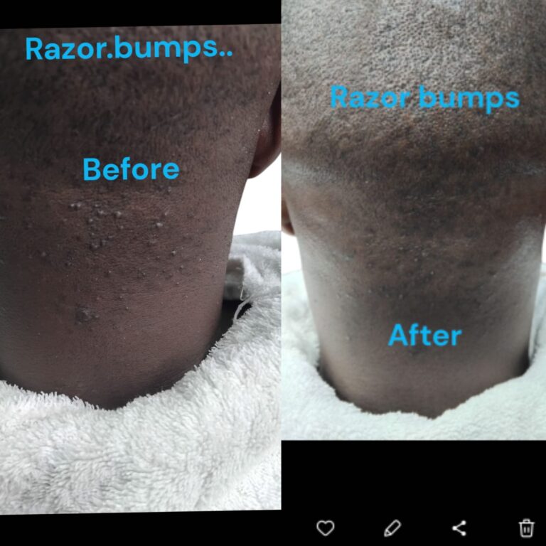 razor treatment royalluxury 7