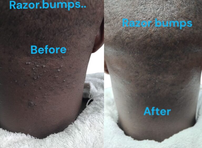 razor treatment royalluxury 7