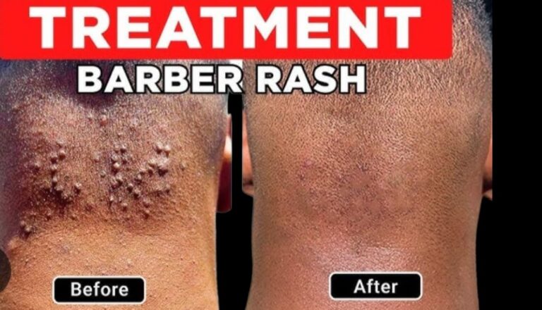 razor treatment royalluxury